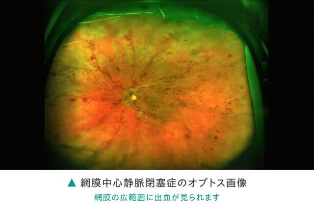 medical-treatment-retinal_disease-retinal_vein_occlusion06