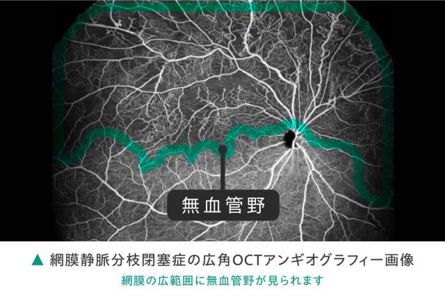 medical-treatment-retinal_disease-retinal_vein_occlusion08