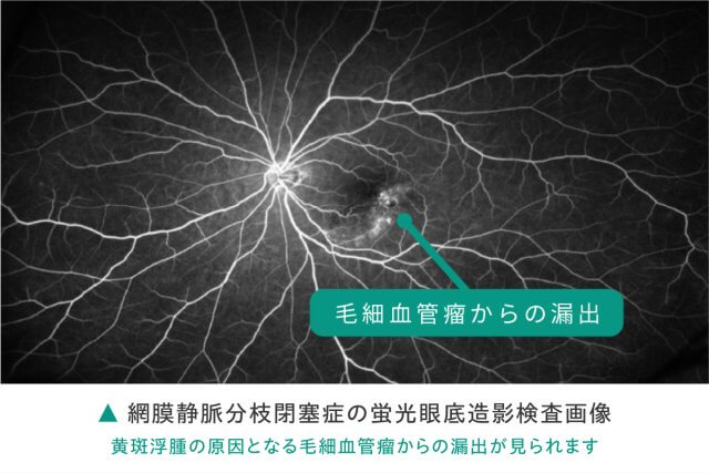 medical-treatment-retinal_disease-retinal_vein_occlusion09